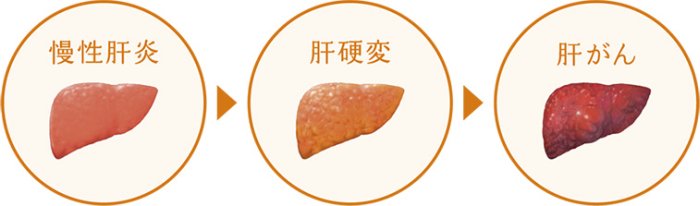 HCV感染から肝がんを発症するプロセス
