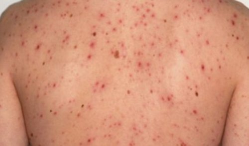 背中に赤い発疹・ぶつぶつができる